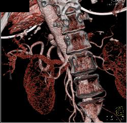 Dissection Extends Into the Celiac Artery - CTisus CT Scan