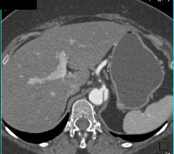 Dissection Extends Into the Celiac Artery - CTisus CT Scan