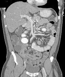 Carcinoid Tumor With Desmoplastic Reaction - CTisus CT Scan