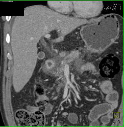 Inflamed Mesentery and Superior Mesenteric Vein (SMV) Thrombus - CTisus CT Scan