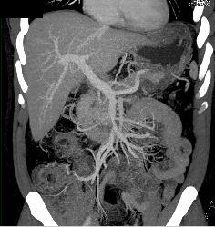 Inflamed Mesentery and Superior Mesenteric Vein (SMV) Thrombus - CTisus CT Scan