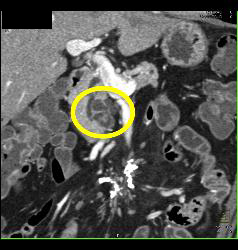 Sclerosing Mesenteritis and Intraductal Papillary Mucinous Neoplasm (IPMN) - 2 Diagnoses - CTisus CT Scan