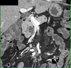 Sclerosing Mesenteritis and Intraductal Papillary Mucinous Neoplasm (IPMN) - 2 Diagnoses - CTisus CT Scan