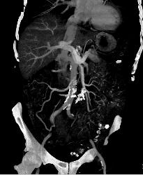 Sclerosing Mesenteritis and Intraductal Papillary Mucinous Neoplasm (IPMN) - 2 Diagnoses - CTisus CT Scan