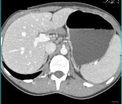 Multiple Desmoid Tumors - CTisus CT Scan