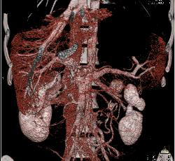 Superior Mesenteric Artery (SMA) Syndrome - CTisus CT Scan