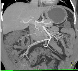 Superior Mesenteric Artery (SMA) Syndrome - CTisus CT Scan