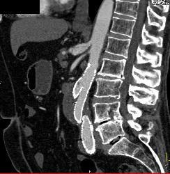 Celiac Artery With Dissection - CTisus CT Scan