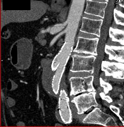 Celiac Artery With Dissection - CTisus CT Scan