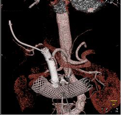 Two Stents in Common Bile Duct (CBD) and One in the Duodenum - CTisus CT Scan