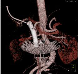 Two Stents in Common Bile Duct (CBD) and One in the Duodenum - CTisus CT Scan