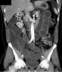 Small Bowel Obstruction (SBO) Due to Adhesions - CTisus CT Scan