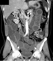 Small Bowel Obstruction (SBO) Due to Adhesions - CTisus CT Scan