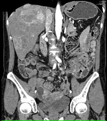 Metastatic Carcinoid to Omentum and Liver - CTisus CT Scan