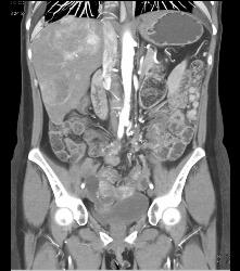 Metastatic Carcinoid to Omentum and Liver - CTisus CT Scan