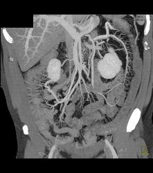 Colitis With Prominent Vasa Recta - CTisus CT Scan