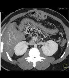 Colitis With Prominent Vasa Recta - CTisus CT Scan