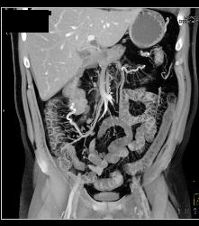 Colitis With Prominent Vasa Recta - CTisus CT Scan