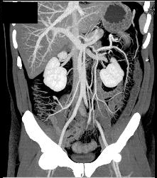 Colitis With Prominent Vasa Recta - CTisus CT Scan