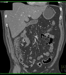 Colitis - CTisus CT Scan