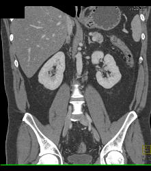 Colitis - CTisus CT Scan