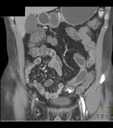 Crohn's Disease Involves Ileum - CTisus CT Scan