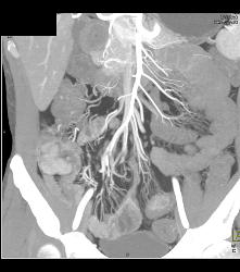 Crohn's Disease Involves Ileum - CTisus CT Scan