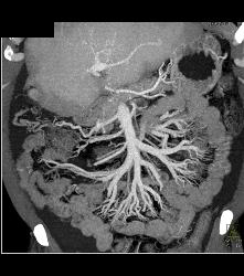 Increased Blood Flow to Mesenteric Vessels - CTisus CT Scan