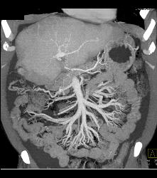 Increased Blood Flow to Mesenteric Vessels - CTisus CT Scan