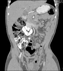 Small Bowel Extends Into Hernia Into Scrotum - CTisus CT Scan