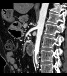 Dilated Gastroduodenal Artery (GDA) Due to Median Arcuate Ligament Syndrome With Celiac Stenosis - CTisus CT Scan