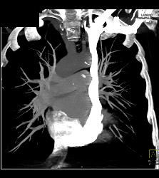 Left Sided Svc - CTisus CT Scan