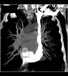 Left Sided SVC - CTisus CT Scan