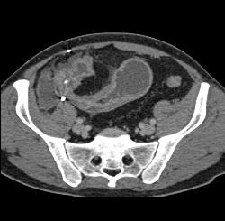 Crohn's Disease With Stenosis and Small Bowel Obstruction (SBO) - CTisus CT Scan