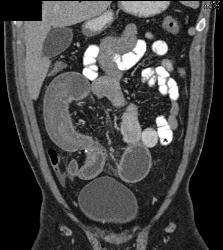 Crohn's Disease With Stenosis and Small Bowel Obstruction (SBO) - CTisus CT Scan