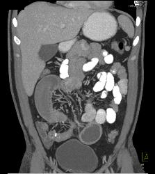 Crohn's Disease With Stenosis and Small Bowel Obstruction (SBO) - CTisus CT Scan