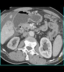 Tumor Infiltrates Superior Mesenteric Artery (SMA) and Peripancreatic Zone- Duodenal Cancer - CTisus CT Scan