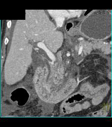 Tumor Infiltrates Superior Mesenteric Artery (SMA) and Peripancreatic Zone- Duodenal Cancer - CTisus CT Scan