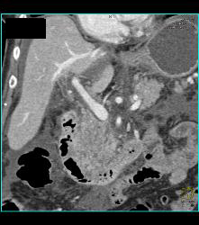 Tumor Infiltrates Superior Mesenteric Artery (SMA) and Peripancreatic Zone- Duodenal Cancer - CTisus CT Scan