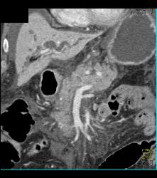 Tumor Infiltrates Superior Mesenteric Artery (SMA) and Peripancreatic Zone- Duodenal Cancer - CTisus CT Scan