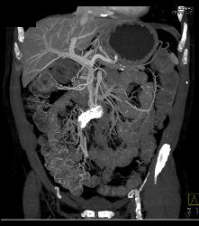 Sclerosing Mesenteritis - CTisus CT Scan