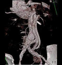 Bypass Grafts for Mesenteric Circulation - CTisus CT Scan