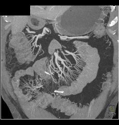 Crohn's Disease With Prominent Vasa Recta - CTisus CT Scan