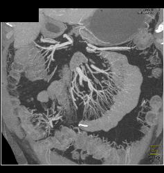 Crohn's Disease With Prominent Vasa Recta - CTisus CT Scan