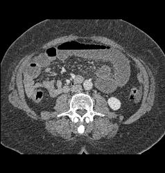 Small Bowel Obstruction (SBO) Due to Incarcerated Inguinal Hernia - CTisus CT Scan