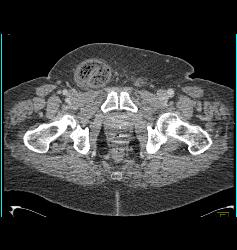 Small Bowel Obstruction (SBO) Due to Incarcerated Inguinal Hernia - CTisus CT Scan