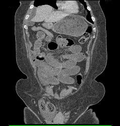 Small Bowel Obstruction (SBO) Due to Incarcerated Inguinal Hernia - CTisus CT Scan