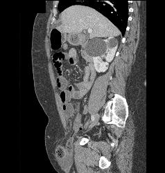 Small Bowel Obstruction (SBO) Due to Incarcerated Inguinal Hernia - CTisus CT Scan