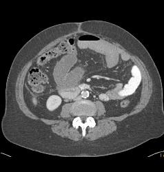 Small Bowel Obstruction (SBO) Due to Incarcerated Inguinal Hernia - CTisus CT Scan