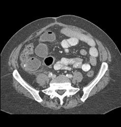 Small Bowel Obstruction (SBO) Due to Incarcerated Inguinal Hernia - CTisus CT Scan